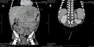 Genetic Profile and Clinical Implications of Hepatoblastoma and Neuroblastoma Coexistence in a Child